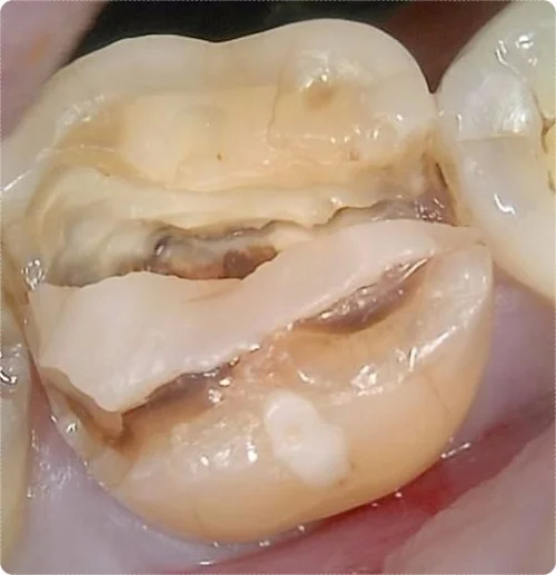 크라운 치료 전 치아 균열이 보이는 오산 크라운치료 사례