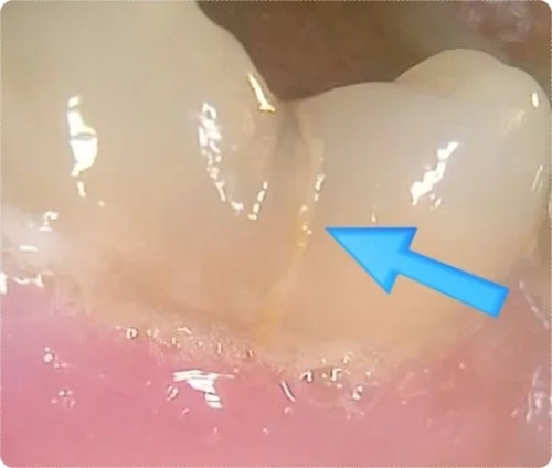 osan crown treatment doctor 12