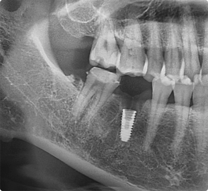 크라운 치료를 하지 않아 발치 후 임플란트 진행된 오산 크라운치료 사례