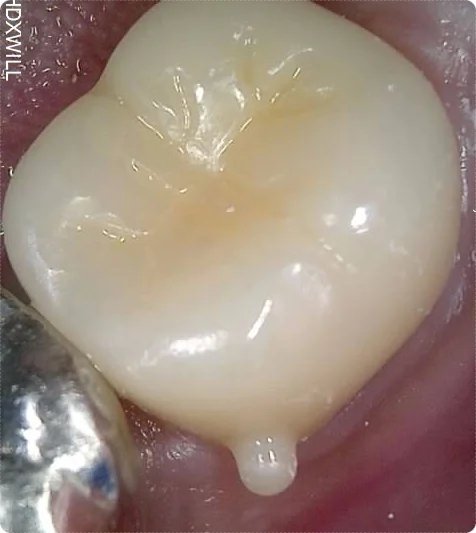 신경치료 후 임시치아를 장착한 오산 크라운치료 환자 치아