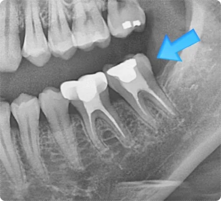 osan crown treatment doctor 6