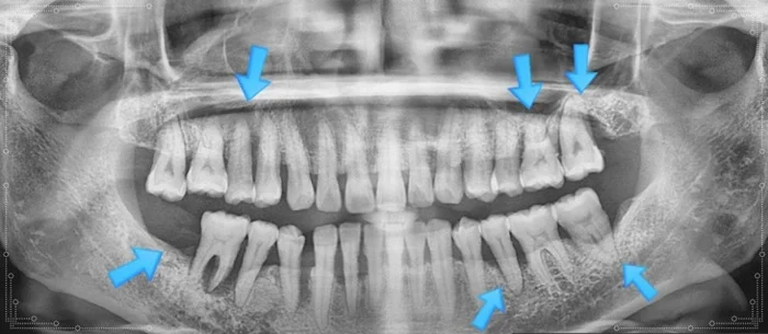 오산 잇몸치료 초진 시 치아 상태 엑스레이