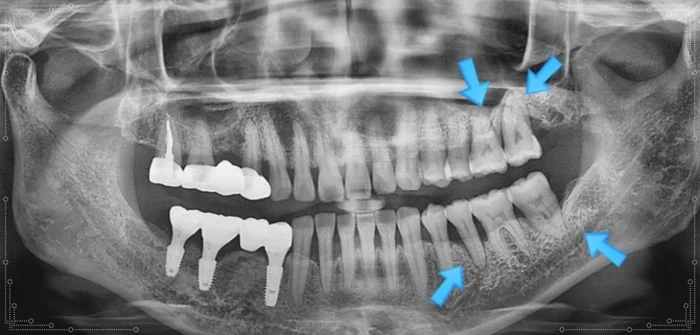오산 잇몸치료 10개월 후 잇몸 회복과 치아 보존 상태 엑스레이