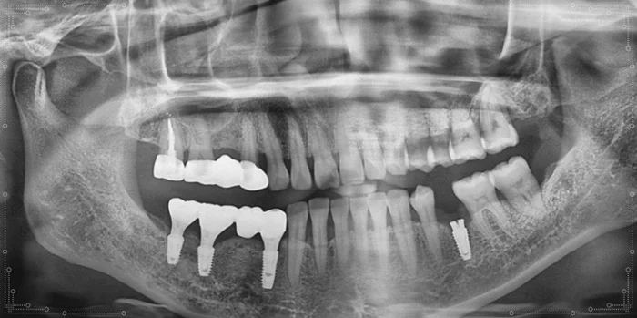 오산 잇몸치료 최종 식립 전 치아 보존 상태 엑스레이