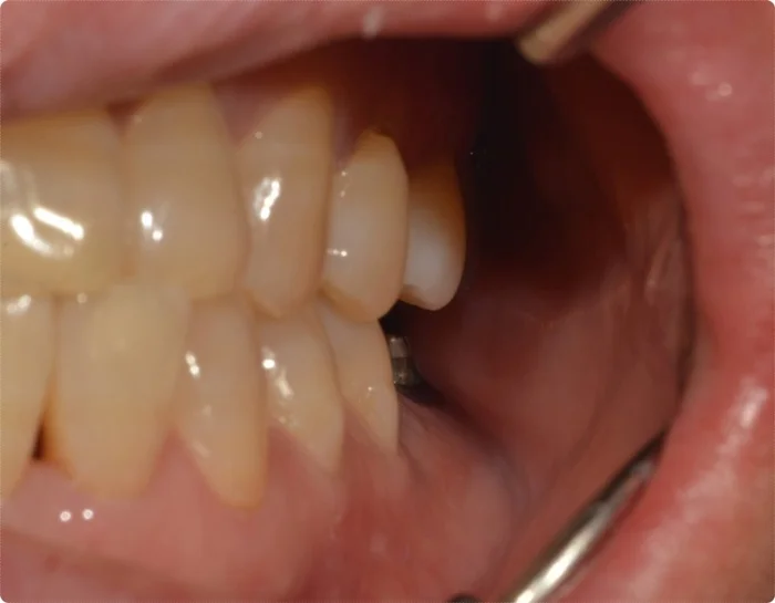 임플란트 전 치아가 없는 상태로 볼과 혀가 빈 공간으로 말린 모습 