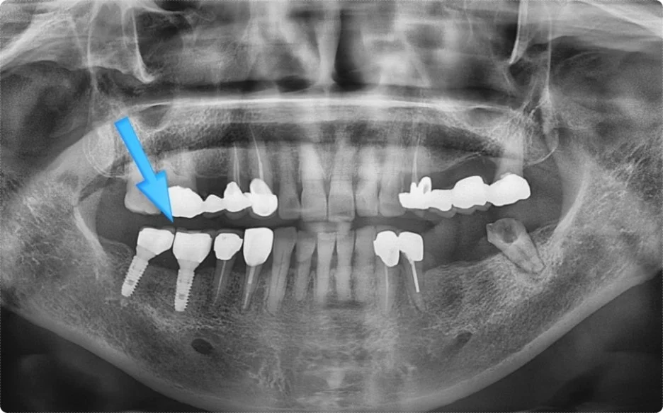 오산 임플란트 파절 3