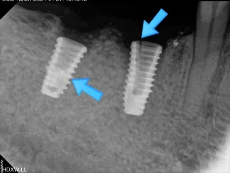 오산 임플란트 흔들림3