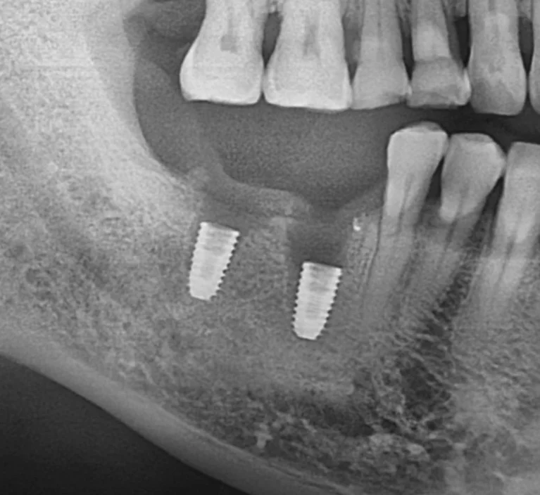 오산 임플란트 흔들림5