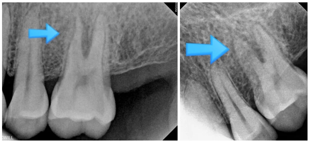 오산 잇몸치료3