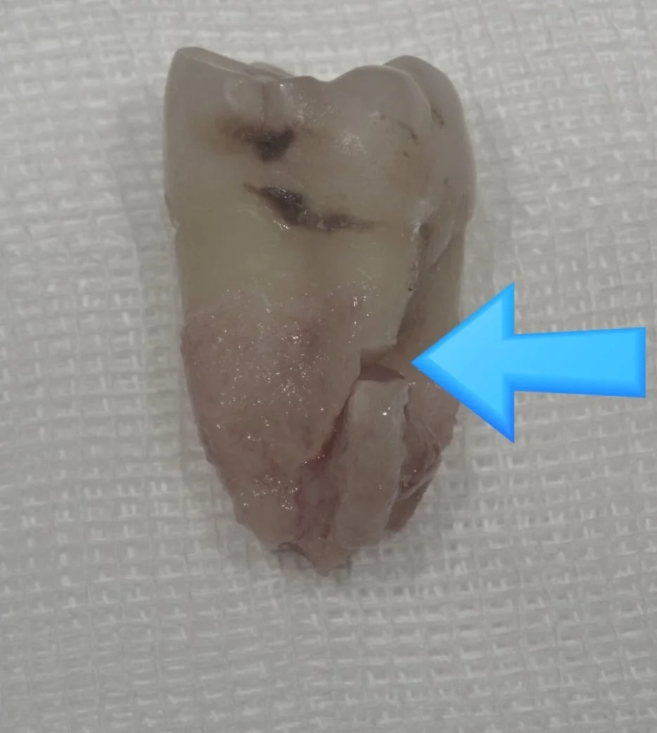 오산 잇몸치료5