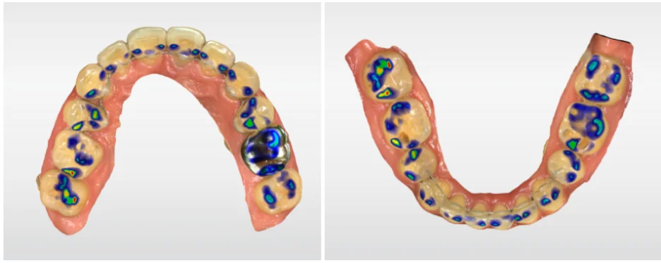 오산 재교정 부분교정 투명교정 3