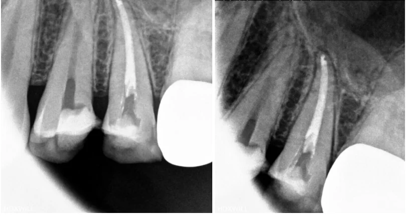 오산 재신경치료2
