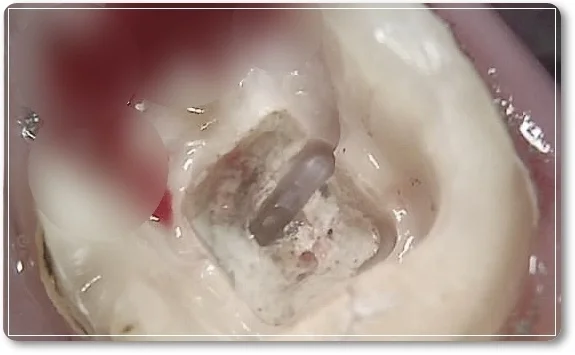 오산 재신경치료 5