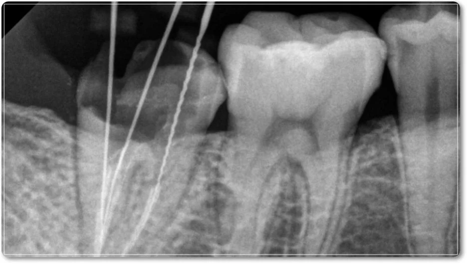 오산 재신경치료 6
