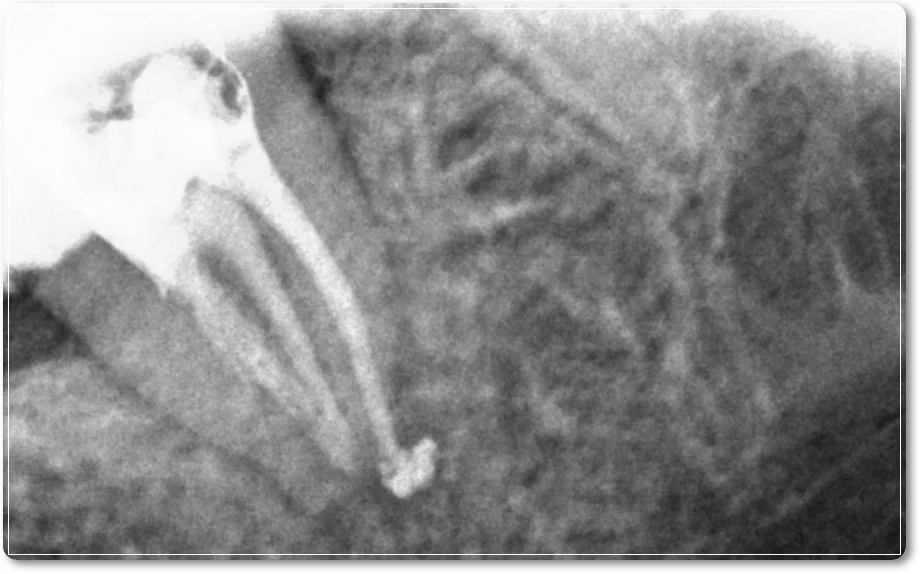 오산 재신경치료 7