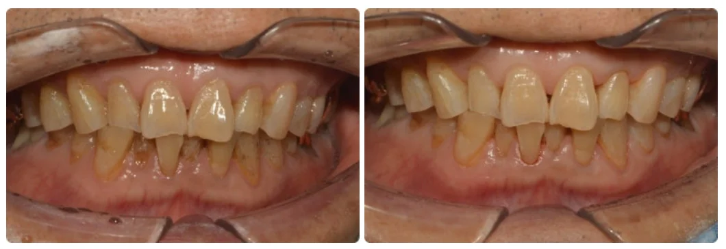 오산 치아 착색6