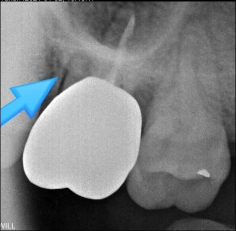 오산 치아진단 엑스레이4