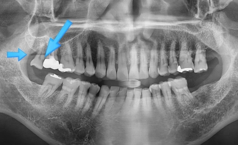오산 사랑니 발치2