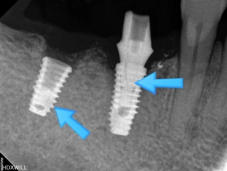 오산 임플란트 흔들림2