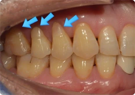 오산 잇몸패임2