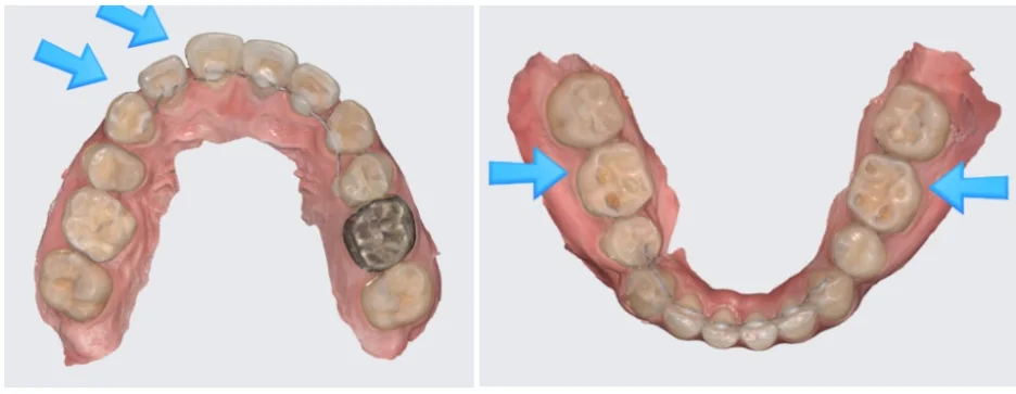 오산 재교정 부분교정 투명교정_2