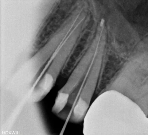 오산 재신경치료4