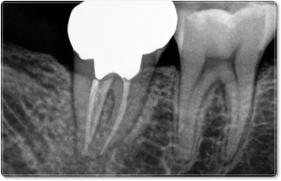 오산 재신경치료_2
