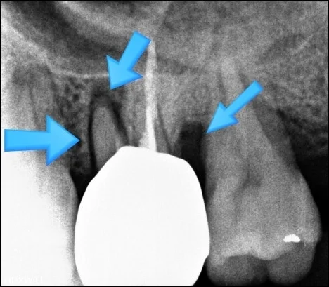 오산 치아진단 엑스레이5